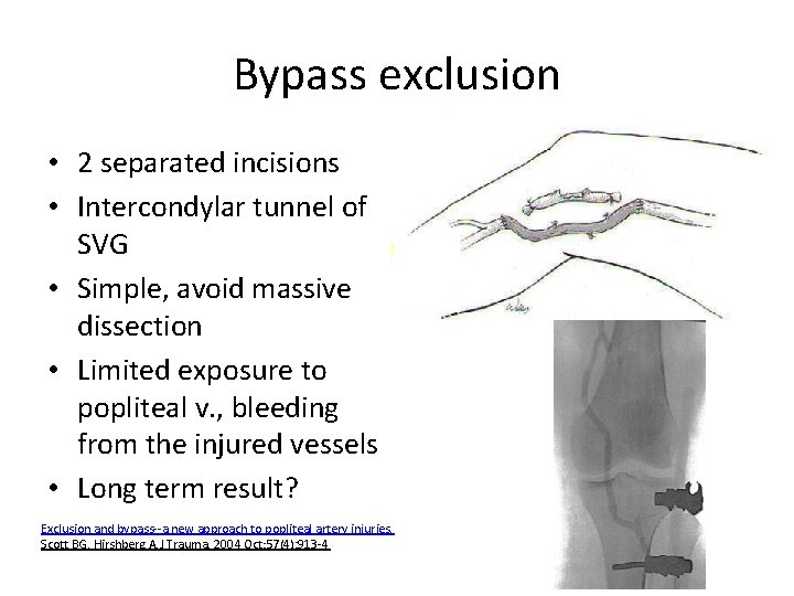 Bypass exclusion • 2 separated incisions • Intercondylar tunnel of SVG • Simple, avoid