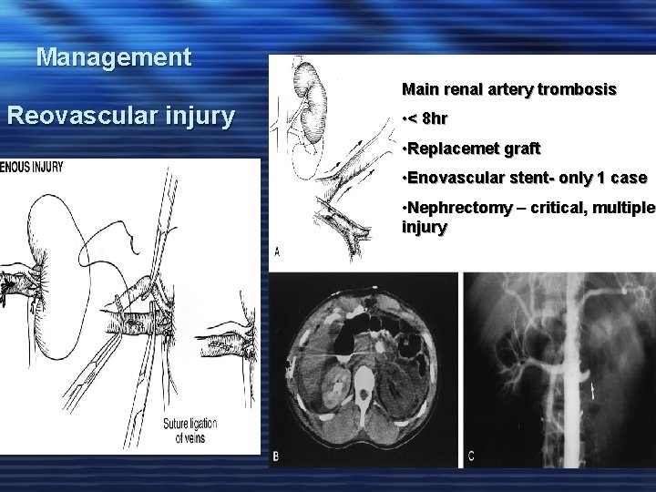 Management Main renal artery trombosis Reovascular injury • < 8 hr • Replacemet graft