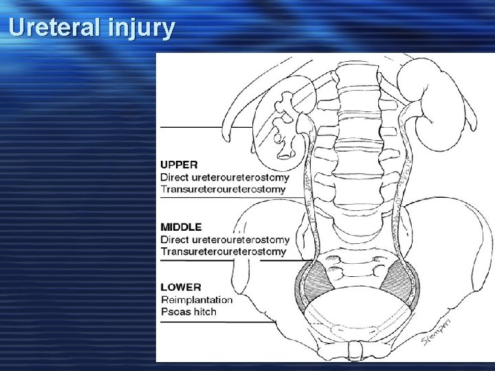 Ureteral injury 