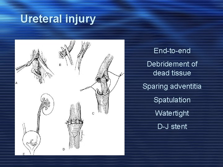 Ureteral injury End-to-end Debridement of dead tissue Sparing adventitia Spatulation Watertight D-J stent 
