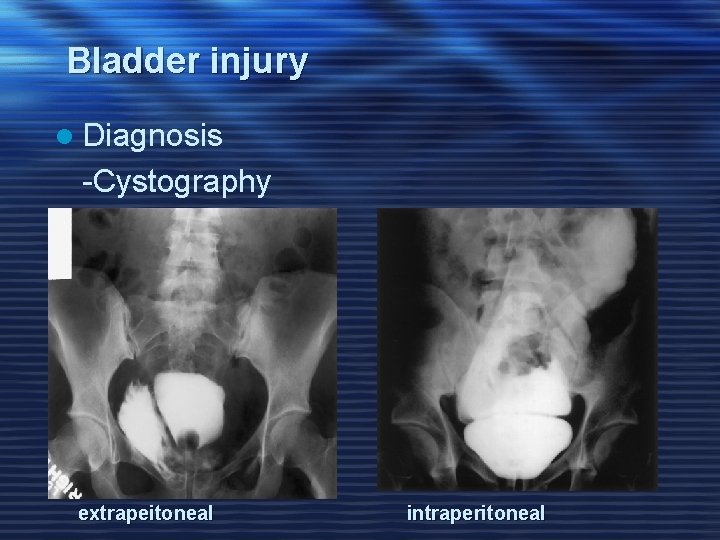 Bladder injury l Diagnosis -Cystography extrapeitoneal intraperitoneal 