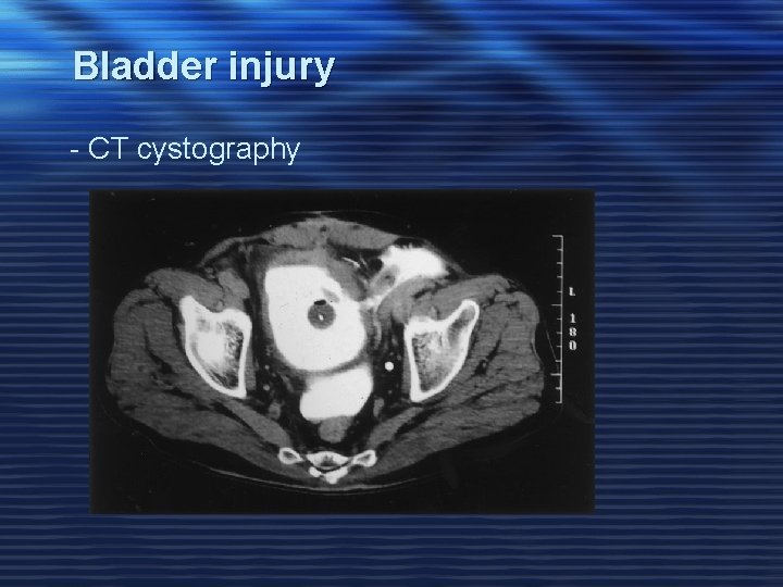 Bladder injury - CT cystography 