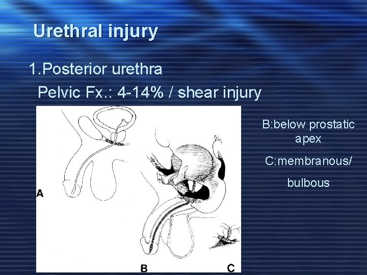 Urethral injury 1. Posterior urethra Pelvic Fx. : 4 -14% / shear injury B: