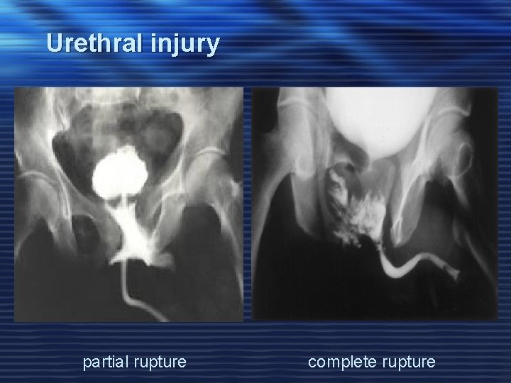 Urethral injury partial rupture complete rupture 