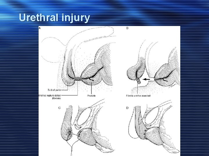 Urethral injury 