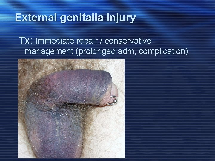 External genitalia injury Tx: Immediate repair / conservative management (prolonged adm, complication) 