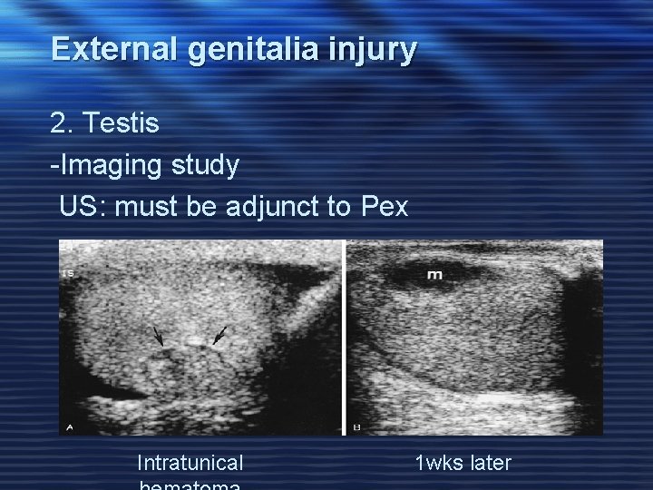 External genitalia injury 2. Testis -Imaging study US: must be adjunct to Pex Intratunical