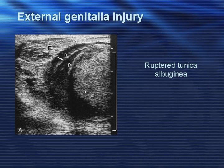 External genitalia injury Ruptered tunica albuginea 