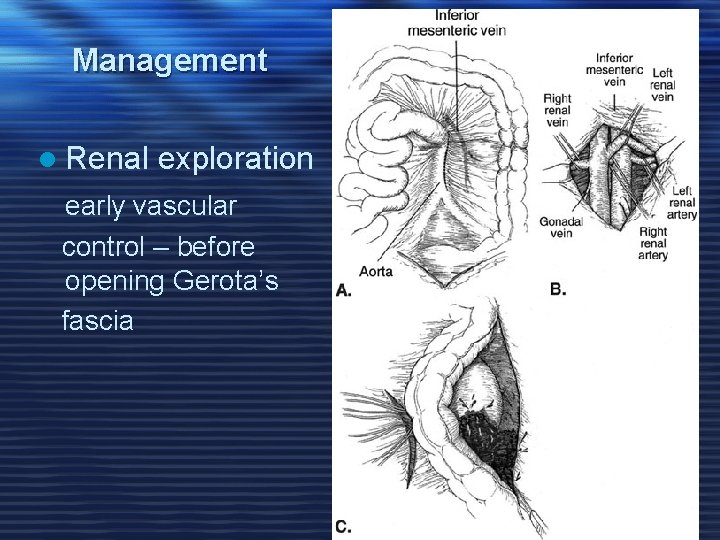 Management l Renal exploration early vascular control – before opening Gerota’s fascia 