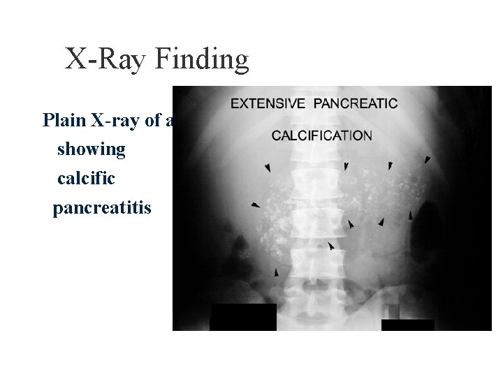X-Ray Finding Plain X-ray of abdomen showing calcific pancreatitis 
