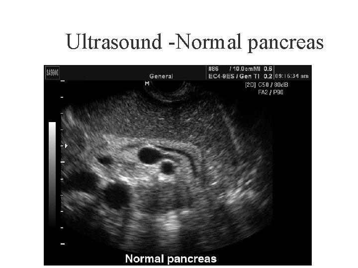 Ultrasound -Normal pancreas 