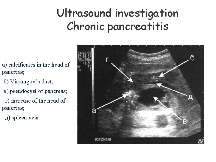 Ultrasound investigation Chronic pancreatitis а) calcificates in the head of pancreas; б) Virsungov’s duct;