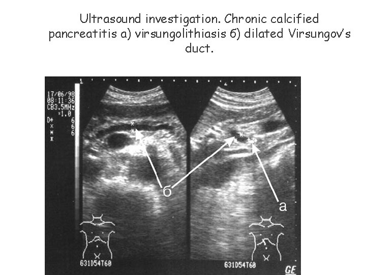 Ultrasound investigation. Chronic calcified pancreatitis а) virsungolithiasis б) dilated Virsungov’s duct. 