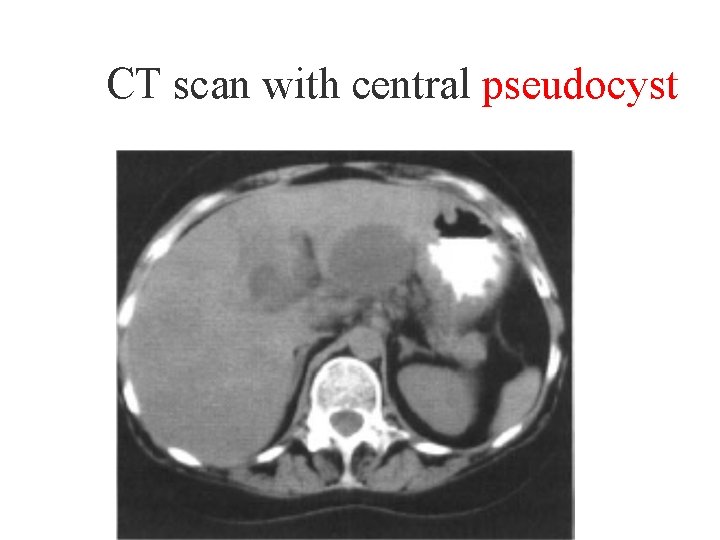 CT scan with central pseudocyst 