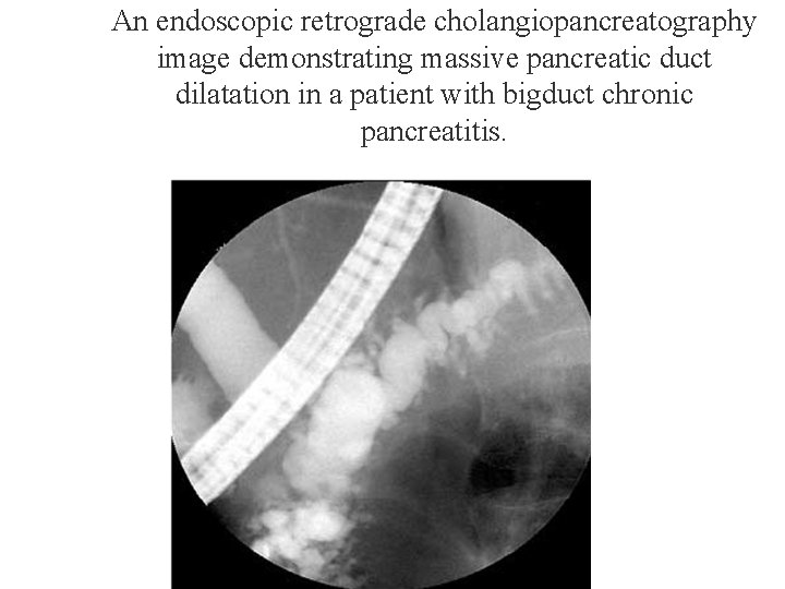 An endoscopic retrograde cholangiopancreatography image demonstrating massive pancreatic duct dilatation in a patient with