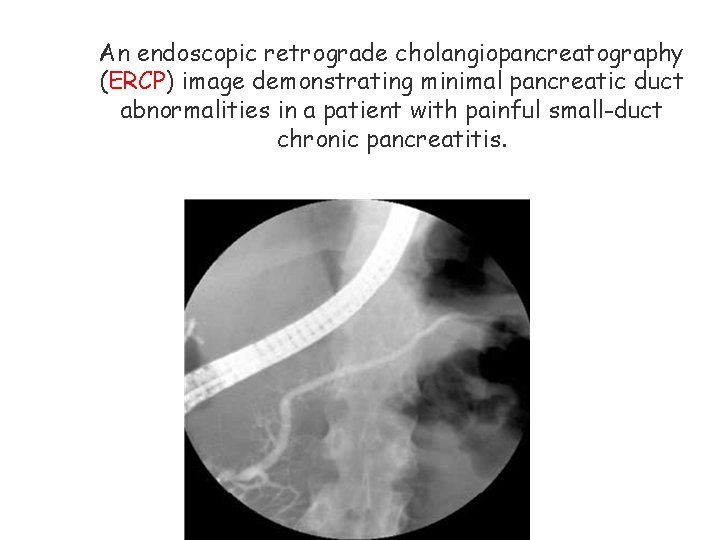 An endoscopic retrograde cholangiopancreatography (ERCP) image demonstrating minimal pancreatic duct abnormalities in a patient