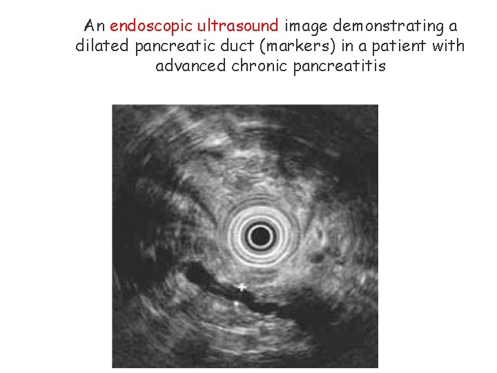 An endoscopic ultrasound image demonstrating a dilated pancreatic duct (markers) in a patient with