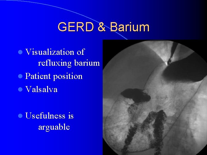 GERD & Barium l Visualization of refluxing barium l Patient position l Valsalva l