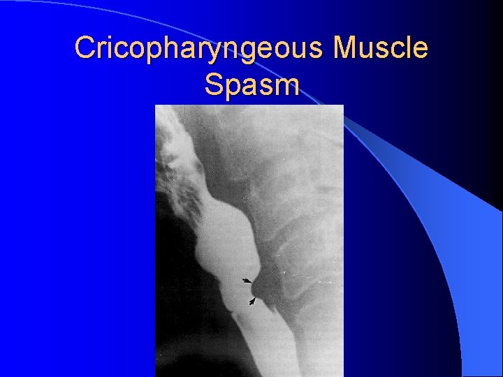 Cricopharyngeous Muscle Spasm 