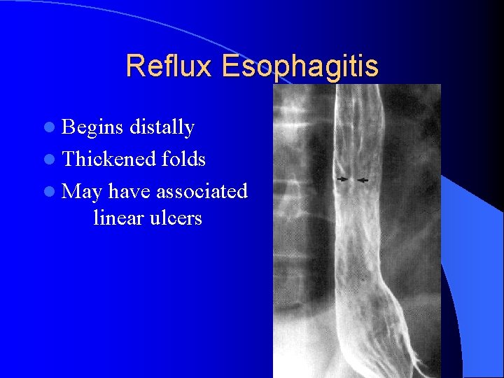 Reflux Esophagitis l Begins distally l Thickened folds l May have associated linear ulcers