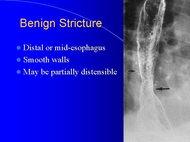 Benign Stricture l Distal or mid-esophagus l Smooth walls l May be partially distensible