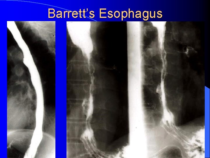 Barrett’s Esophagus 