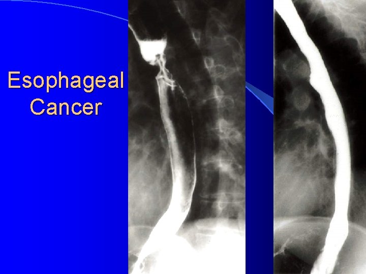 Esophageal Cancer 