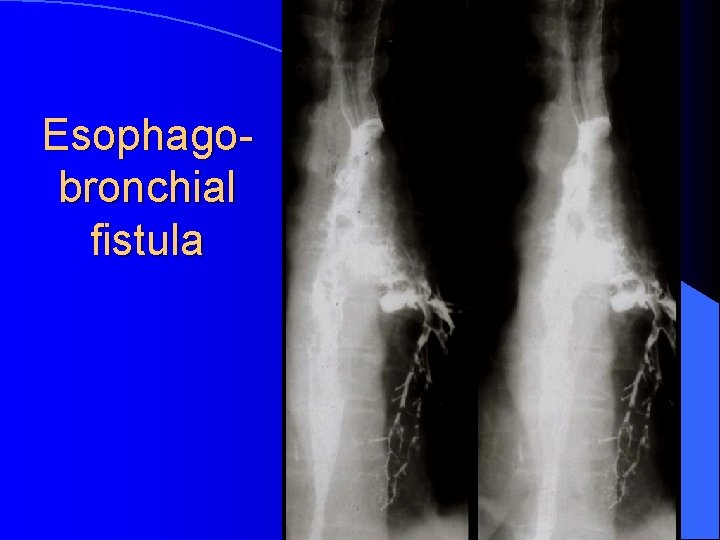 Esophagobronchial fistula 