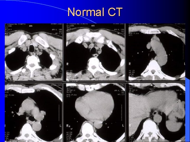 Normal CT 