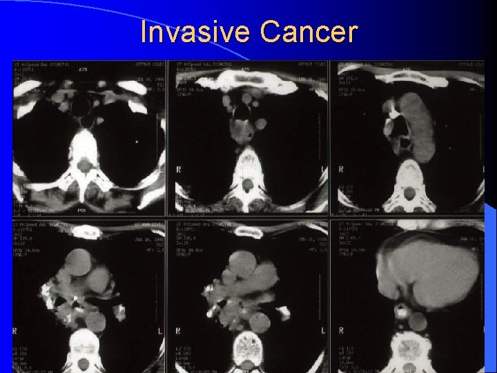 Invasive Cancer 