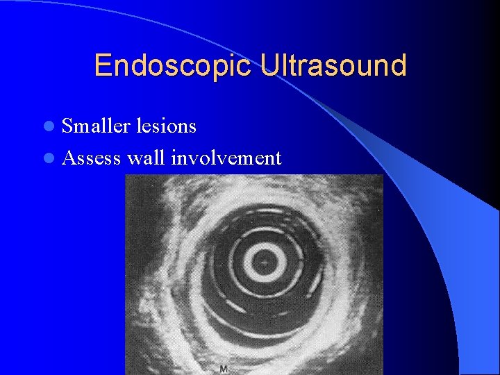Endoscopic Ultrasound l Smaller lesions l Assess wall involvement 