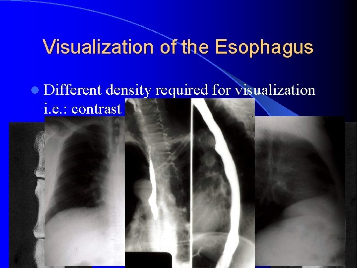 Visualization of the Esophagus l Different density required for visualization i. e. : contrast