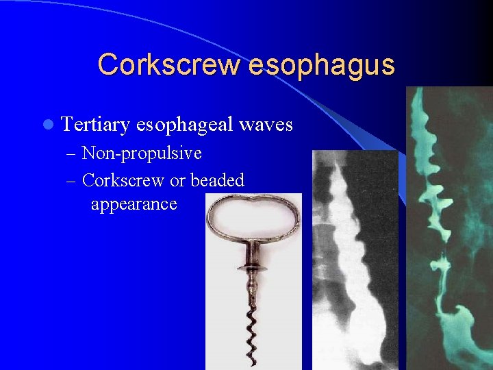 Corkscrew esophagus l Tertiary esophageal waves – Non-propulsive – Corkscrew or beaded appearance 