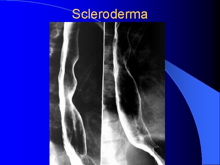 Scleroderma 