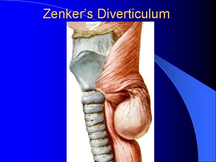 Zenker’s Diverticulum 