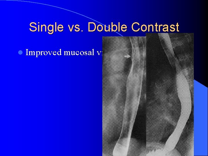 Single vs. Double Contrast l Improved mucosal visualization 