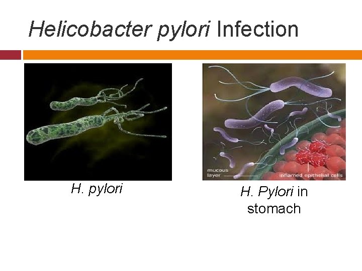 Helicobacter pylori Infection H. pylori H. Pylori in stomach 