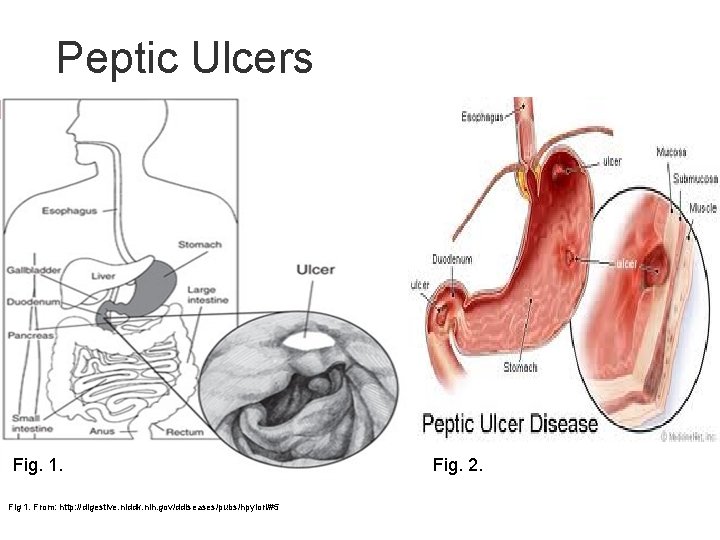 Peptic Ulcers Fig. 1. Fig 1. From: http: //digestive. niddk. nih. gov/ddiseases/pubs/hpylori/#5 Fig. 2.