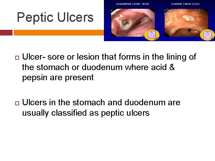Peptic Ulcers Ulcer- sore or lesion that forms in the lining of the stomach