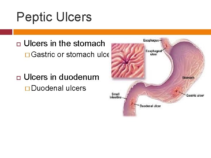 Peptic Ulcers in the stomach � Gastric or stomach ulcers Ulcers in duodenum �