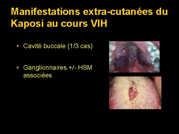 Manifestations extra-cutanées du Kaposi au cours VIH • Cavité buccale (1/3 cas) • Ganglionnaires