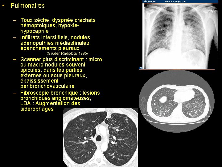  • Pulmonaires – Toux sèche, dyspnée, crachats hémoptoiques, hypoxiehypocapnie – Infiltrats interstitiels, nodules,