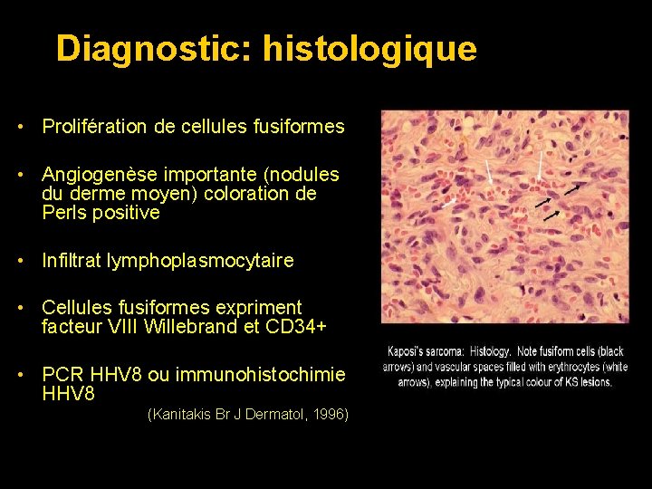 Diagnostic: histologique • Prolifération de cellules fusiformes • Angiogenèse importante (nodules du derme moyen)