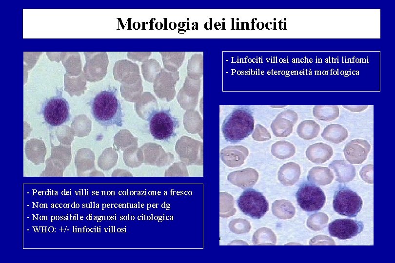 Morfologia dei linfociti Linfociti villosi anche in altri linfomi Possibile eterogeneità morfologica Perdita dei