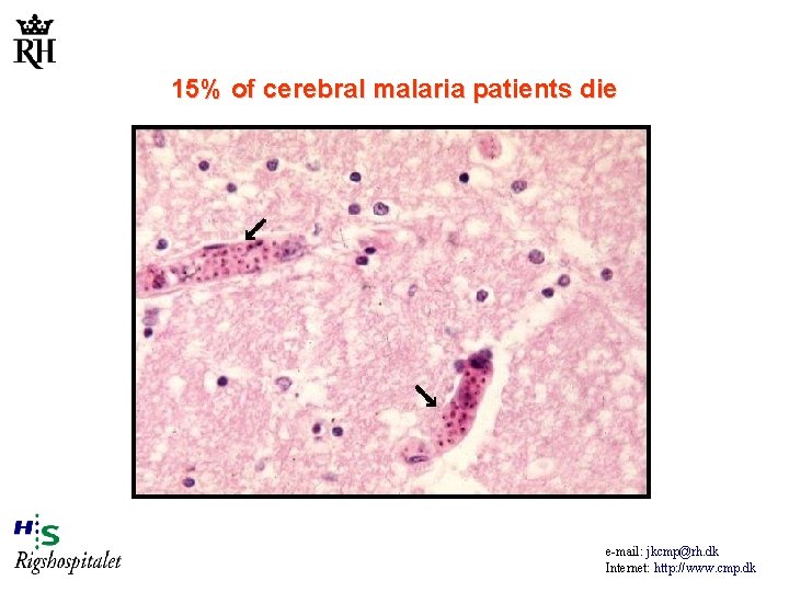 15% of cerebral malaria patients die e-mail: jkcmp@rh. dk Internet: http: //www. cmp. dk