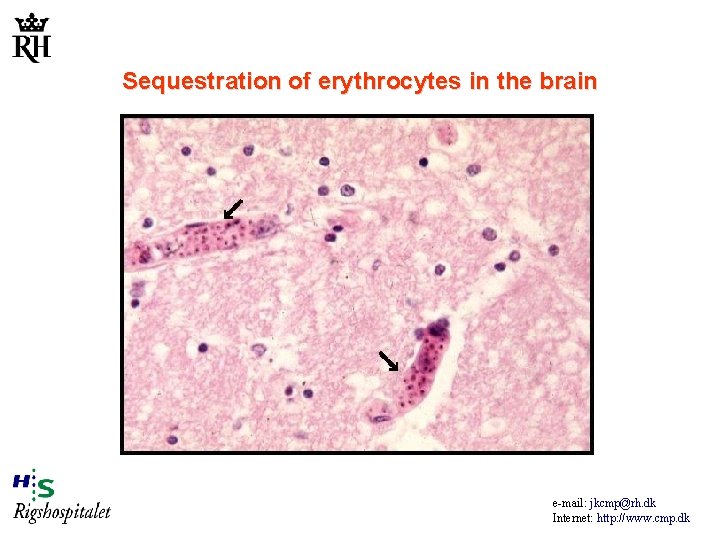 Sequestration of erythrocytes in the brain e-mail: jkcmp@rh. dk Internet: http: //www. cmp. dk