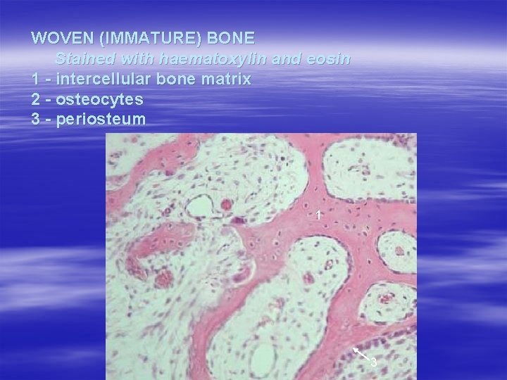 WOVEN (IMMATURE) BONE Stained with haematoxylin and eosin 1 - intercellular bone matrix 2