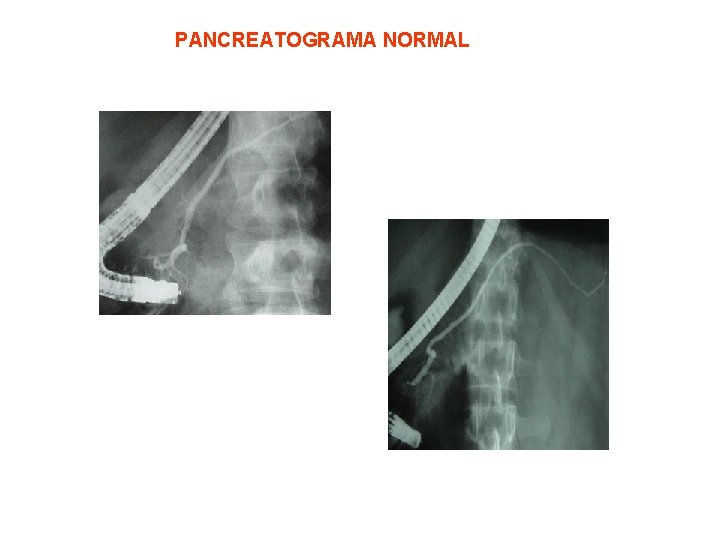 PANCREATOGRAMA NORMAL 
