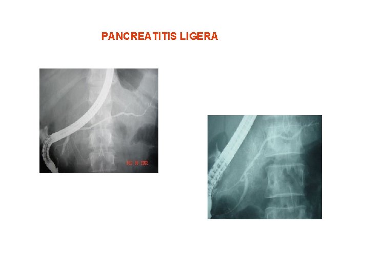 PANCREATITIS LIGERA 
