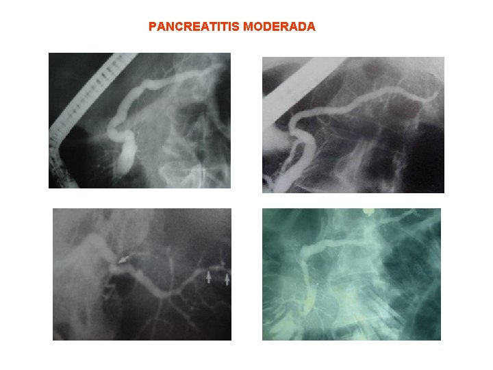 PANCREATITIS MODERADA 